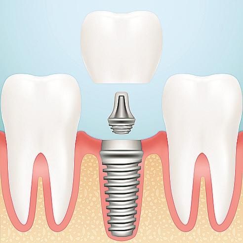 种植牙不能来月经吗怎么办-种植牙齿会影响月经推迟吗(图1)
