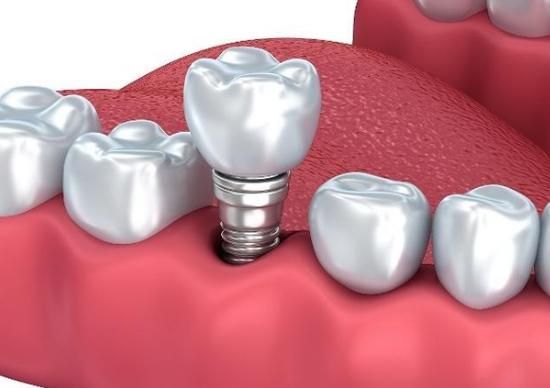 种植牙不能来月经吗怎么办-种植牙齿会影响月经推迟吗(图3)