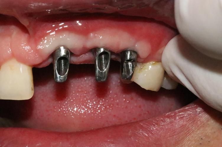 种植牙对应牙套-种植牙带牙套(图3)