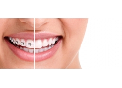 矫正牙龈出血牙齿松动（矫正 牙龈出血）(图3)