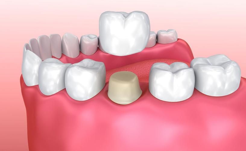 西安靠谱矫正牙齿（西安牙齿矫正十大口碑医院）(图2)