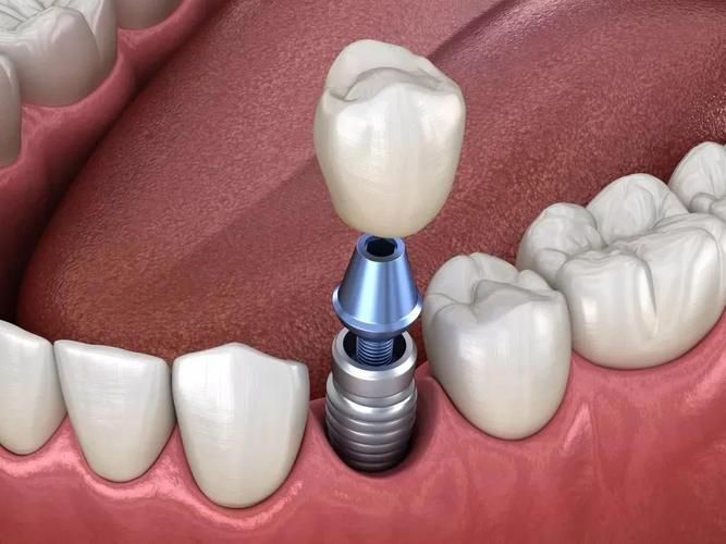 口腔牙齿预备修复病例书写（口腔前牙修复病例）(图3)
