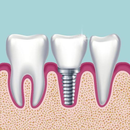 大连种植牙齿时间安排多久-大连种植牙齿多少钱一颗?(图2)