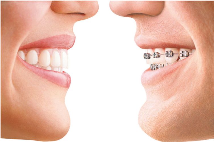 矫正牙齿后缩凸嘴（牙齿矫正后变凸嘴）(图2)