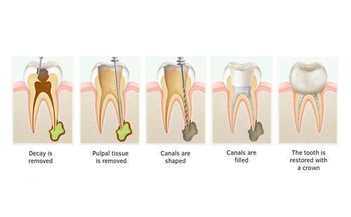 种植牙安装周期-种植牙齿需要多长时间能安装到位(图1)