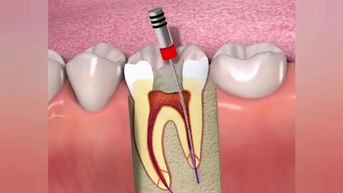 矫正牙齿的时候牙齿会疼吗（矫正牙齿会不会痛?）(图1)
