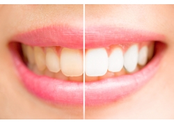 牙齿矫正后的照片（牙齿矫正后的照片怎么拍）(图3)