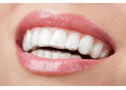 戴上牙套多久可以种植牙-戴上牙套后多久可以拔牙(图2)