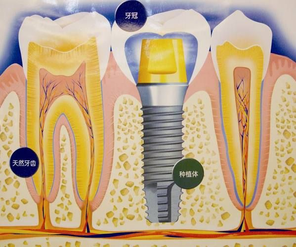 西安种植牙齿哪个医院好点-西安种植牙齿哪个医院好?(图2)